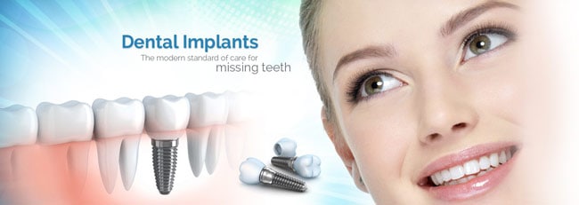 Dental Implant: Definition, Benefits, Types of implant