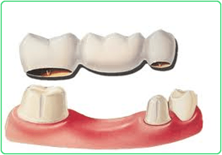 dental bridge