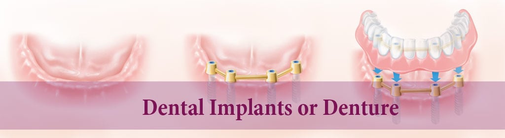 Differences between implants and dentures