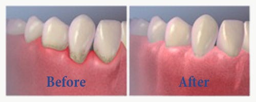 gingivial flap surgery