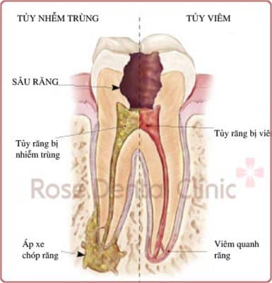 Tooth structure