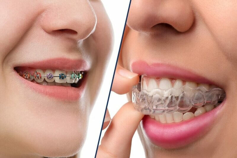 Learn about braces with traditional braces and clear braces