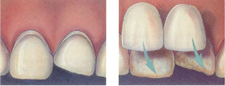 porcelain veneer procedure