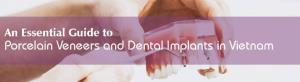 An Essential Guide to Porcelain Veneers and Dental Implants
