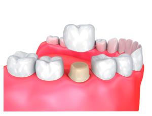Get to know about many types of dental crowns