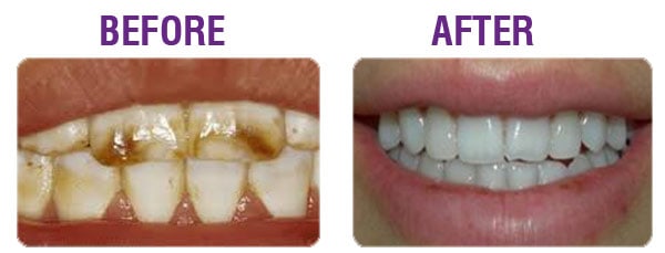 teeth-stained-fluoride