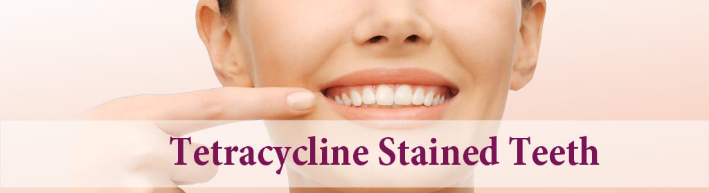 Tetracycline stained teeth: Harm, Causes and Treatment