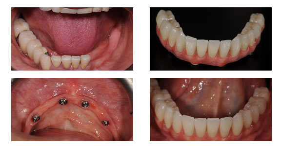 Immediate replacement teeth