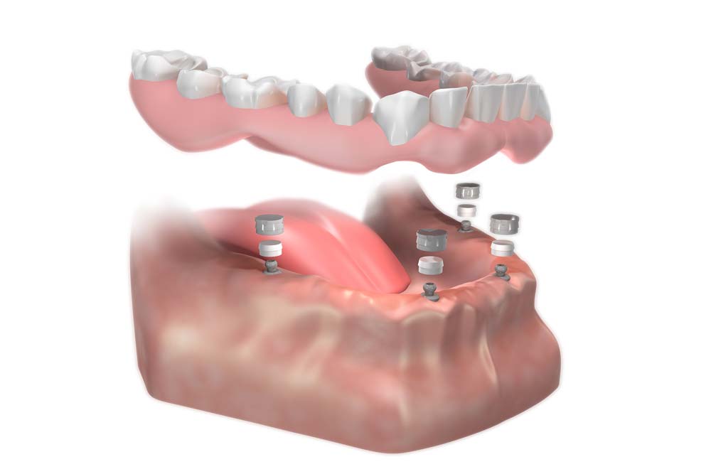 All On 4 uses only four dental implants 