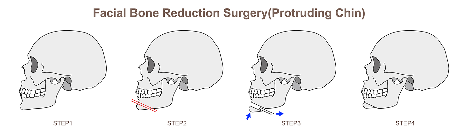 Protruding Upper Jaw Surgery - Wassmund and Koler Surgery