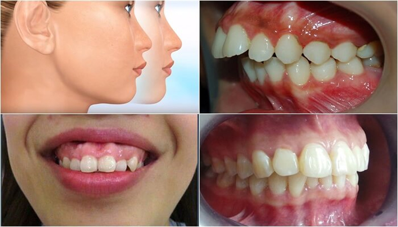 Protruding Upper Jaw Surgery - Wassmund and Koler Surgery