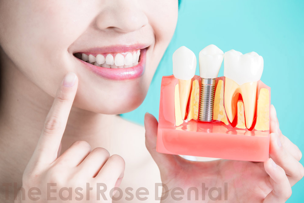 Why Should You Choose Dental Implants - East Rose Dental Clinic