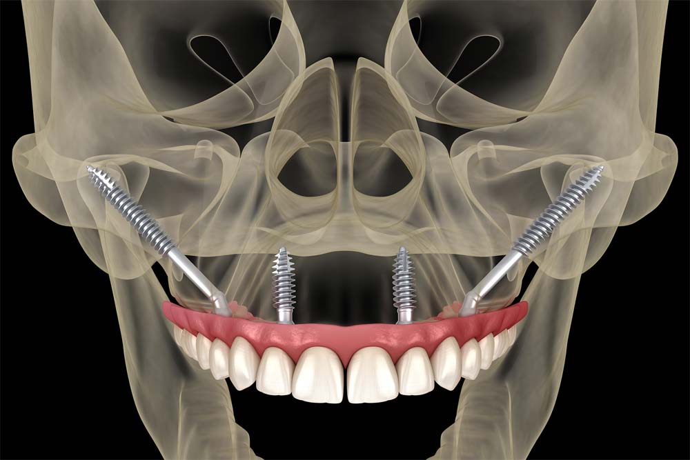 Benefits of zygomatic Implant in patients with severe bone loss