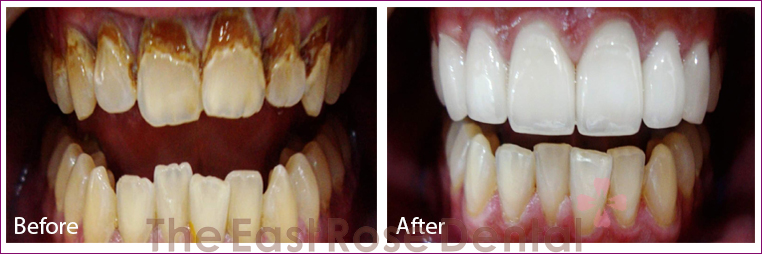 After and Before using Eastrosedental porcelain veneer service