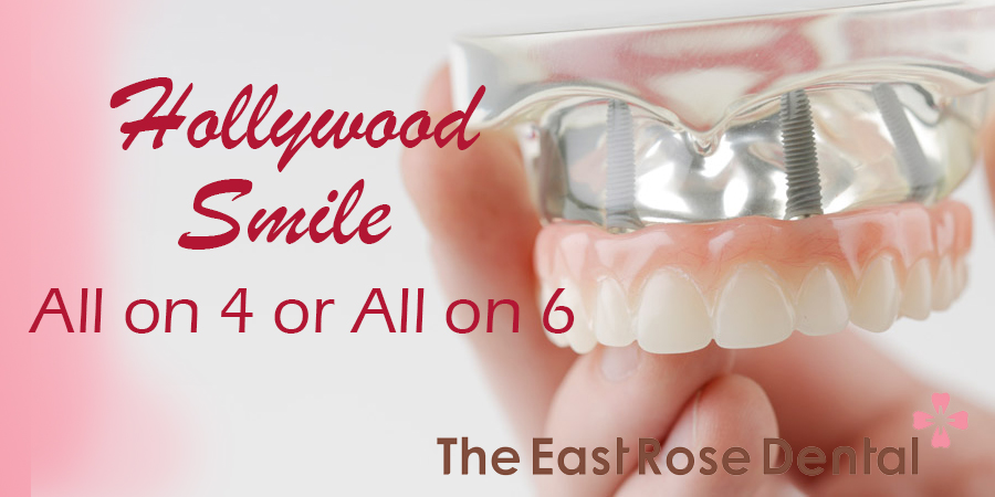 How to get a nice smile – A Hollywood smile for Edentulous