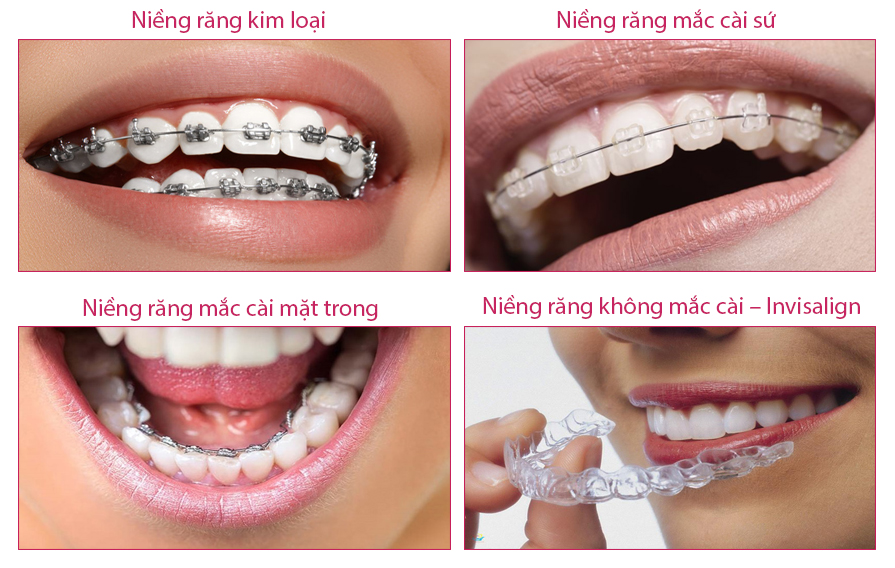 4 loại niềng răng trên thị trường hiện nay