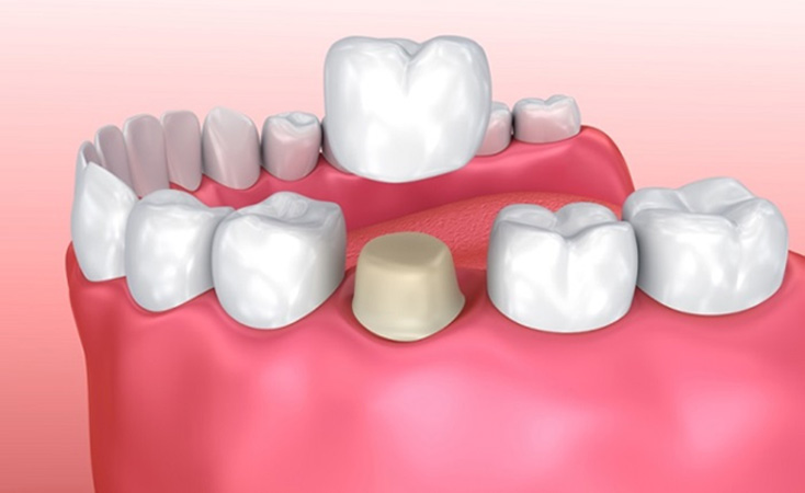 Giải pháp thứ 2 : Răng toàn sứ Zirconia