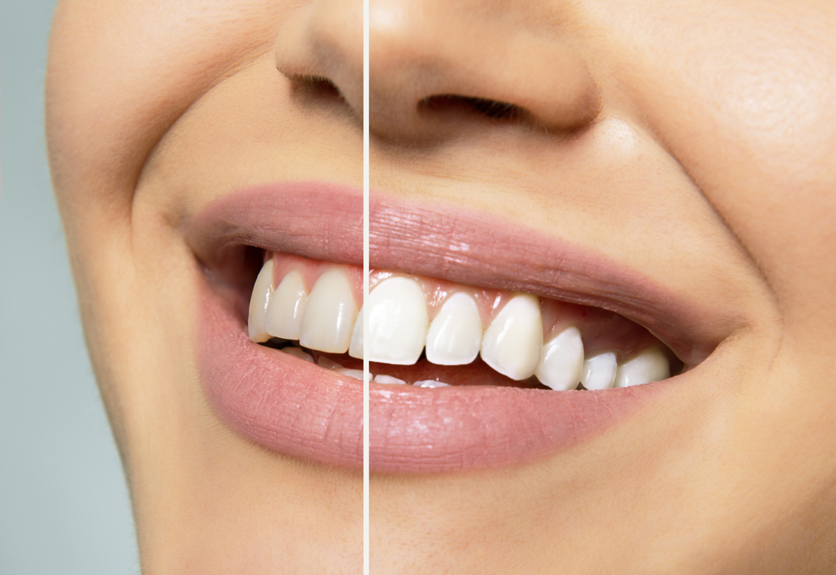 Before - after case dental at the east rose dental clinic