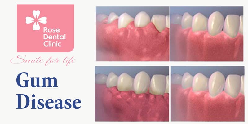 What is Periodontal Disease and Types of Gum surgery?