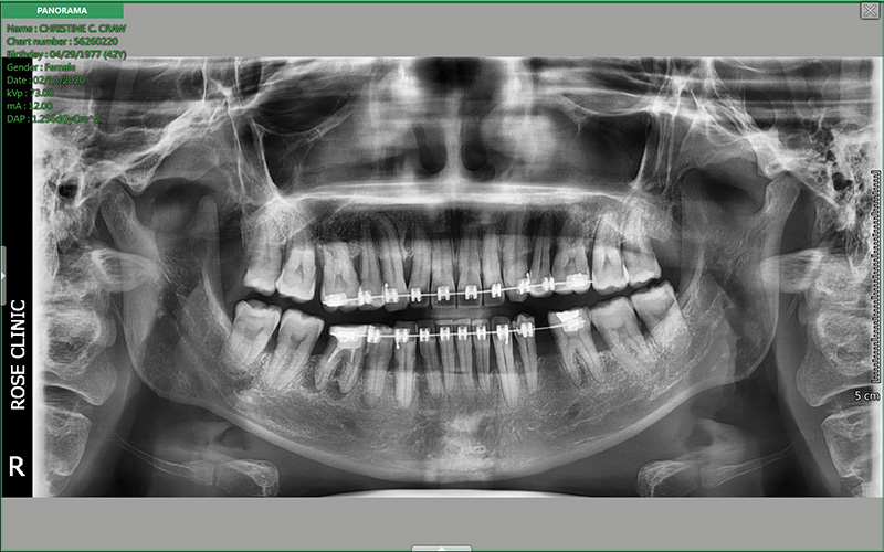 failure braces