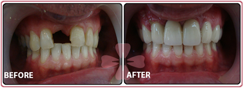 Dental implant + Zirconia full 10