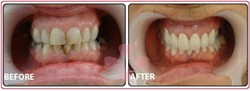 20 did full ceramic Zirconia