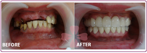 Implant - ceramic Zirconia