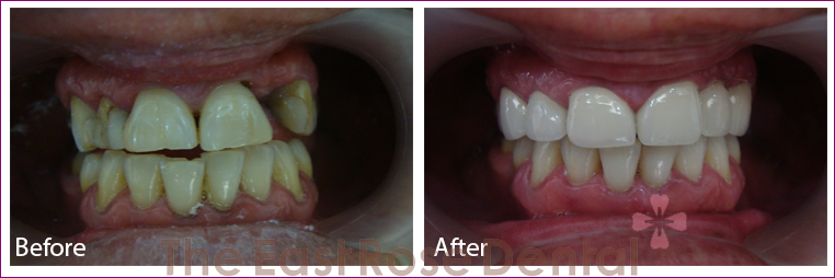 Case cấy ghép implant tại Nha Khoa Hoa Hồng Phương Đông 2