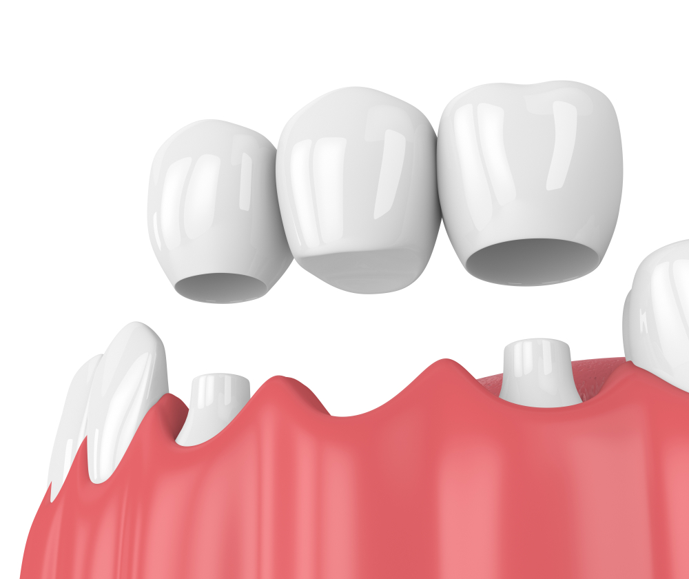 Overview of Dental Bridge Procedure