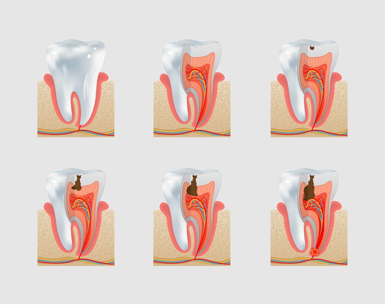 cavities early stages