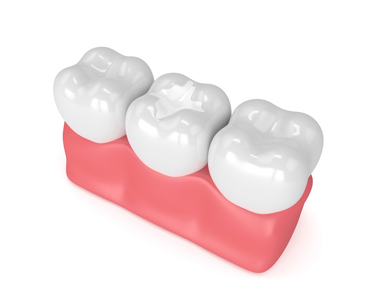 What are the advantages of composite cosmetic dental filling?