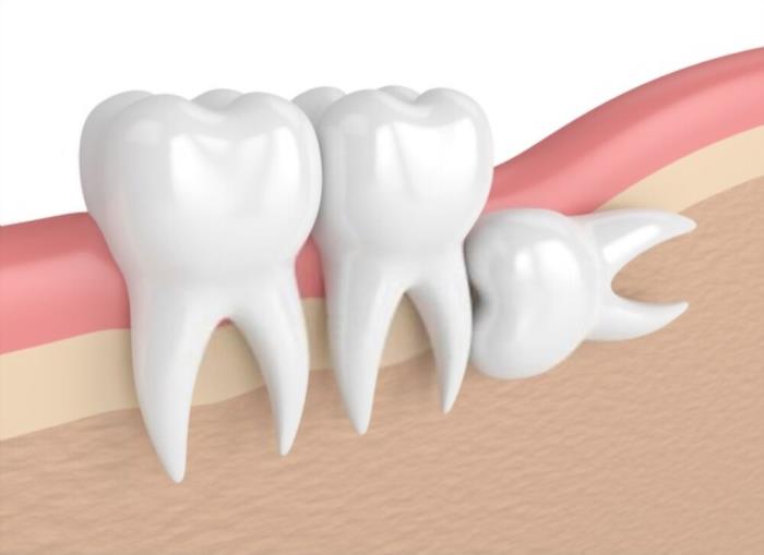 wisdom tooth