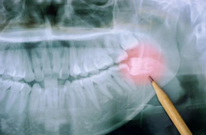 How long does wisdom tooth pain last