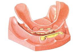 02 Implants + 01 Metal Bar Dolder + An Over Denture with USA resin teeth (RP4)