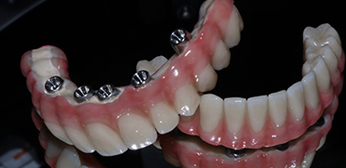 All-on-5 (FP3) for the Scew Prosthesis & Immediate Loading