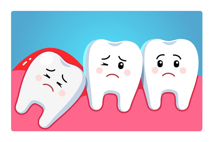 Impacted wisdom teeth and complications