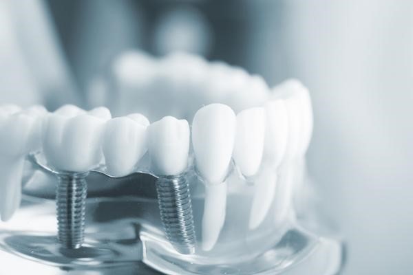 Facts about dental implants