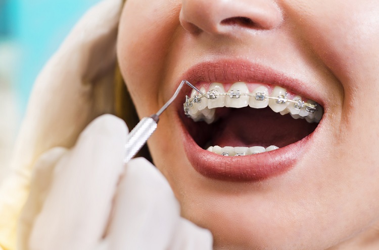 Overview of dental braces: what you need to know