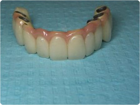 overdenture