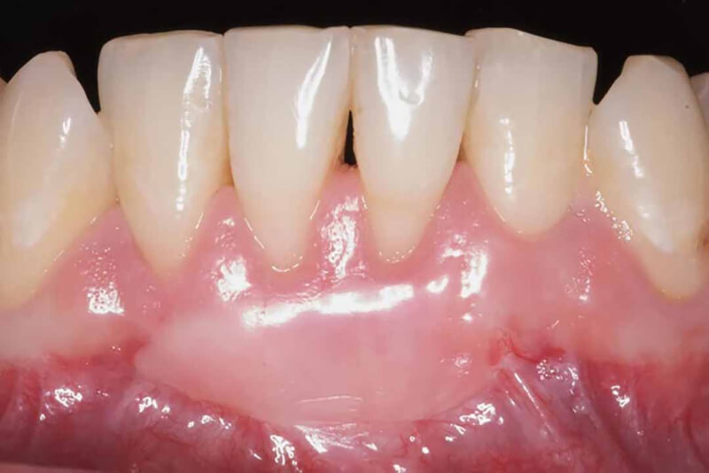 Should cosmetic gum surgery be chosen for people with receding gums?