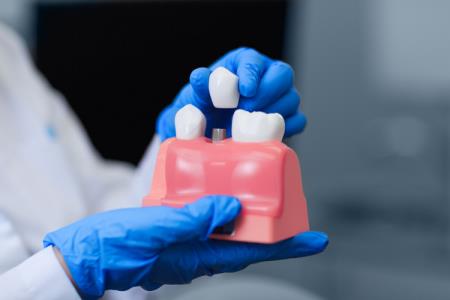 Quá trình trồng răng implant mất bao lâu?