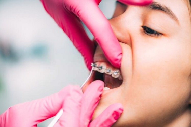 What to do if wires or bands on your braces come loose