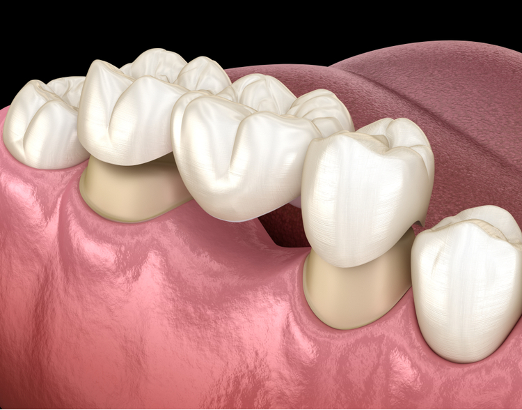 dental bridges