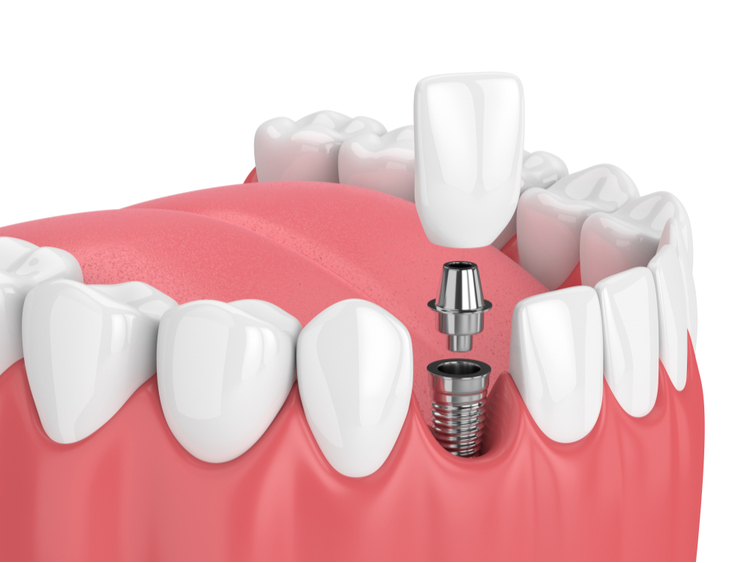 dental implants