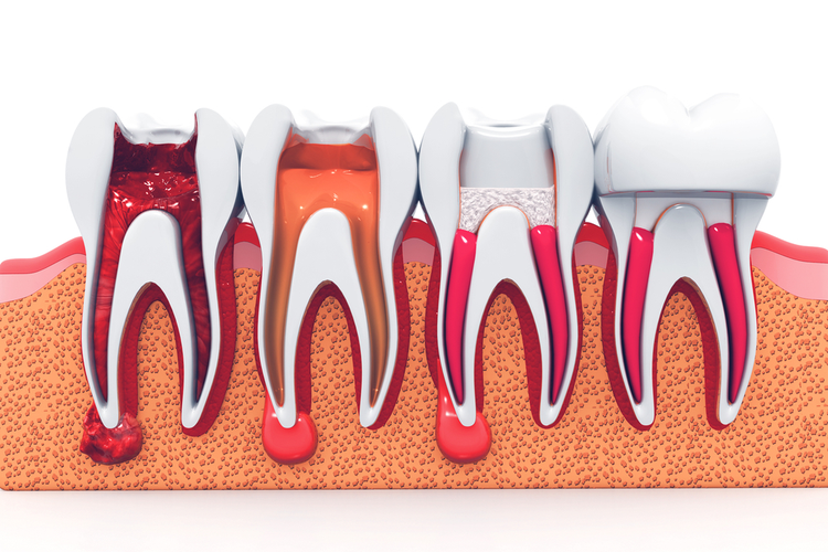 Standard root canal procedure